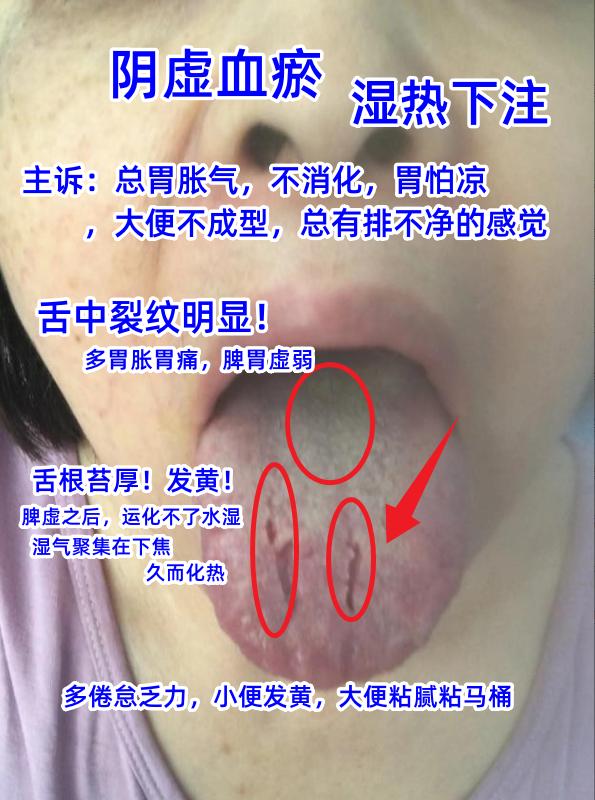 今日舌诊案例分析：寒湿血瘀，肝郁气滞，湿热下注[谢谢][谢谢][谢谢]