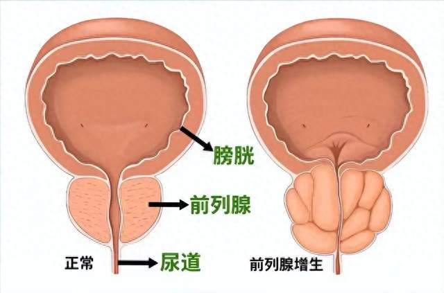 医生发现：能活到90岁的前列腺人，基本在60岁，就已经不做5件事