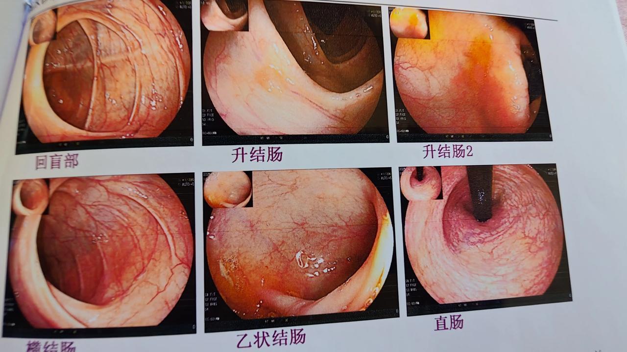 胃镜和肠镜体验报告：有痛检查
一次难忘的健康之旅

大家好，今天我终于预约到了胃