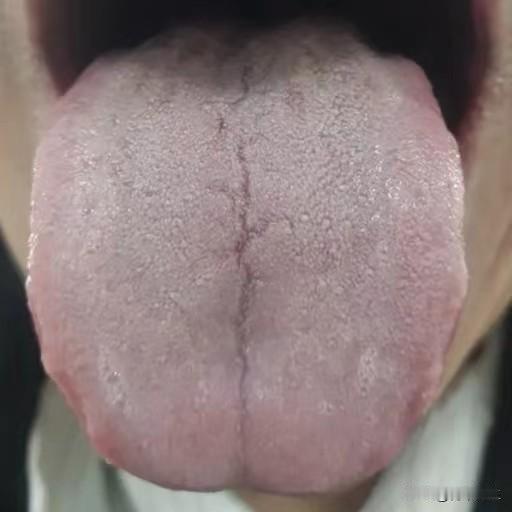 舌象分析：阴寒内生 难怪软短难坚！
1、“舌苔白，发灰，整体舌色偏暗”——体内寒