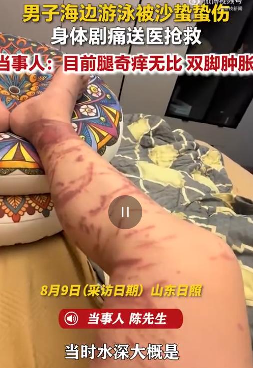 8月9日，山东日照万平口正规海水浴场发生一起惊险的近海中毒事件。
 
一名男子在