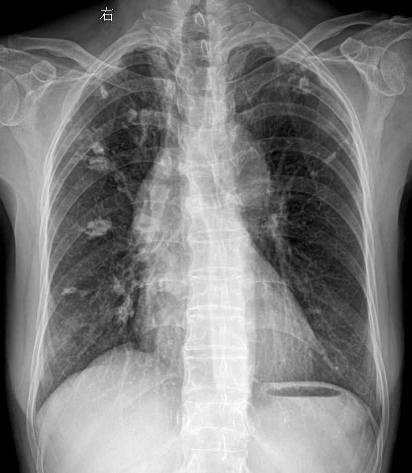 回归工作 双肺可见高密度影钙化灶？陈旧性肺结核？主诉:女 68y 胸闷...