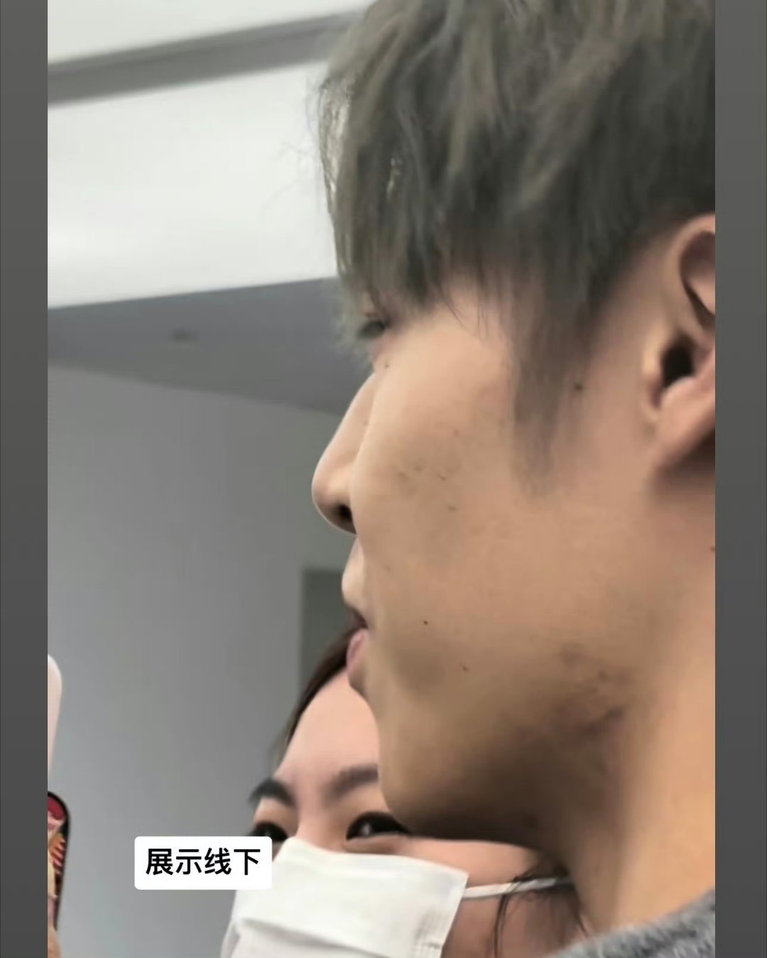 韩汶栩的脸怎么了这个皮肤状态有些吓人了吧和精修图差好多啊。 