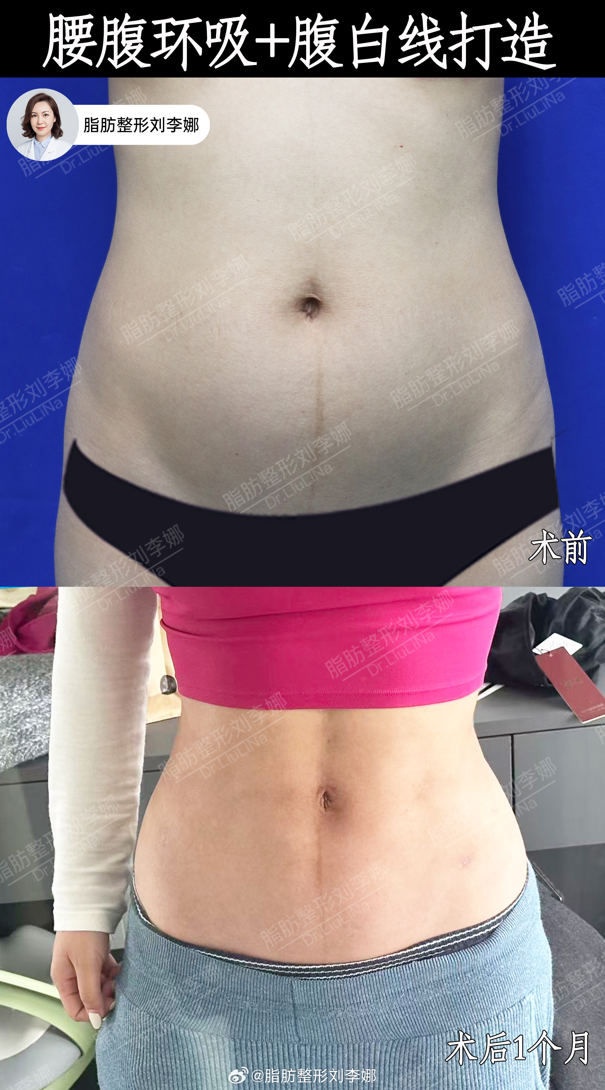 脂肪整形刘李娜腰腹吸脂腰腹抽脂 术前腰腹脂肪堆积、腹部凸出明显，臃肿扁平没有线条