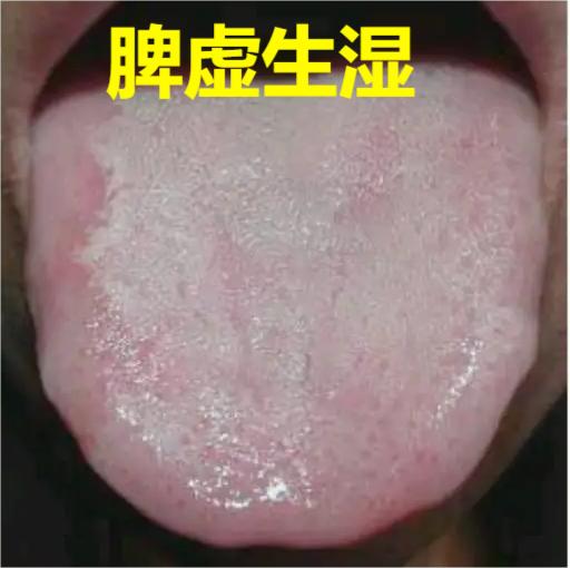 男人最怕阴囊潮湿，分享几个药，帮你横扫湿热，让你无湿一身轻！
1、脾虚生湿
原因
