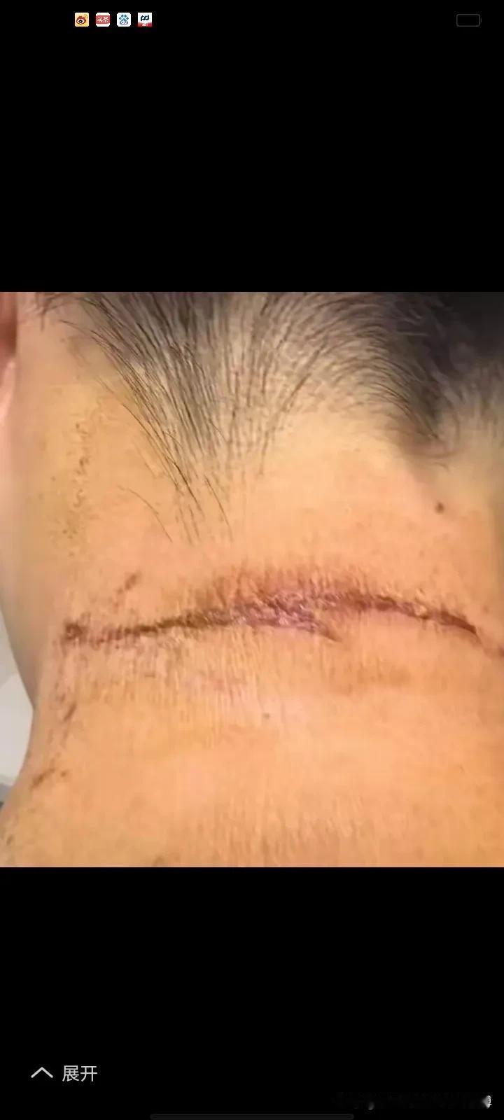 毒液似硫酸，杭州女子摸脖“中招”，隐翅虫千万别碰！

近日，一则令人揪心的新闻引