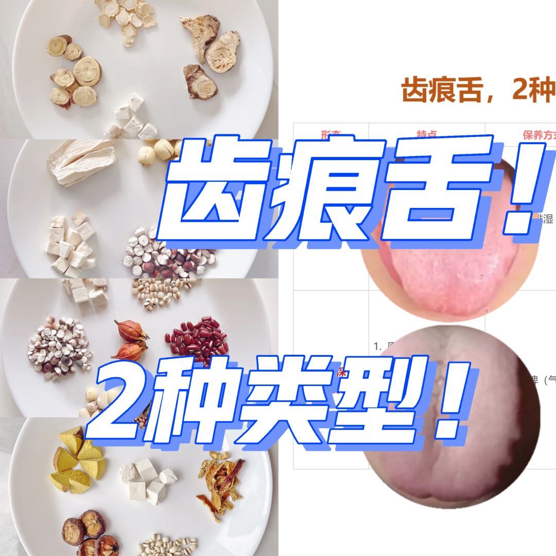 齿痕怎么办：1类化湿2类养脾👆分类对待