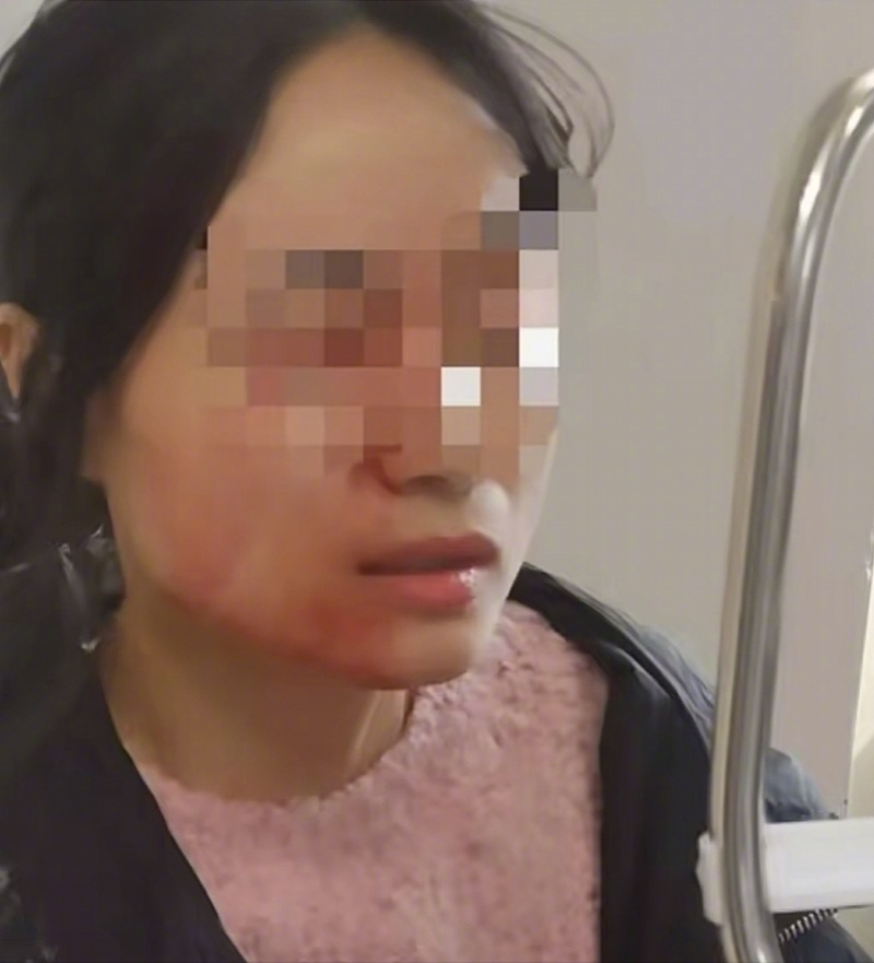 #教育局回应被戳伤眼球教师想调岗#【瑞安市教育局回应“被学生戳伤眼的教师想调岗”