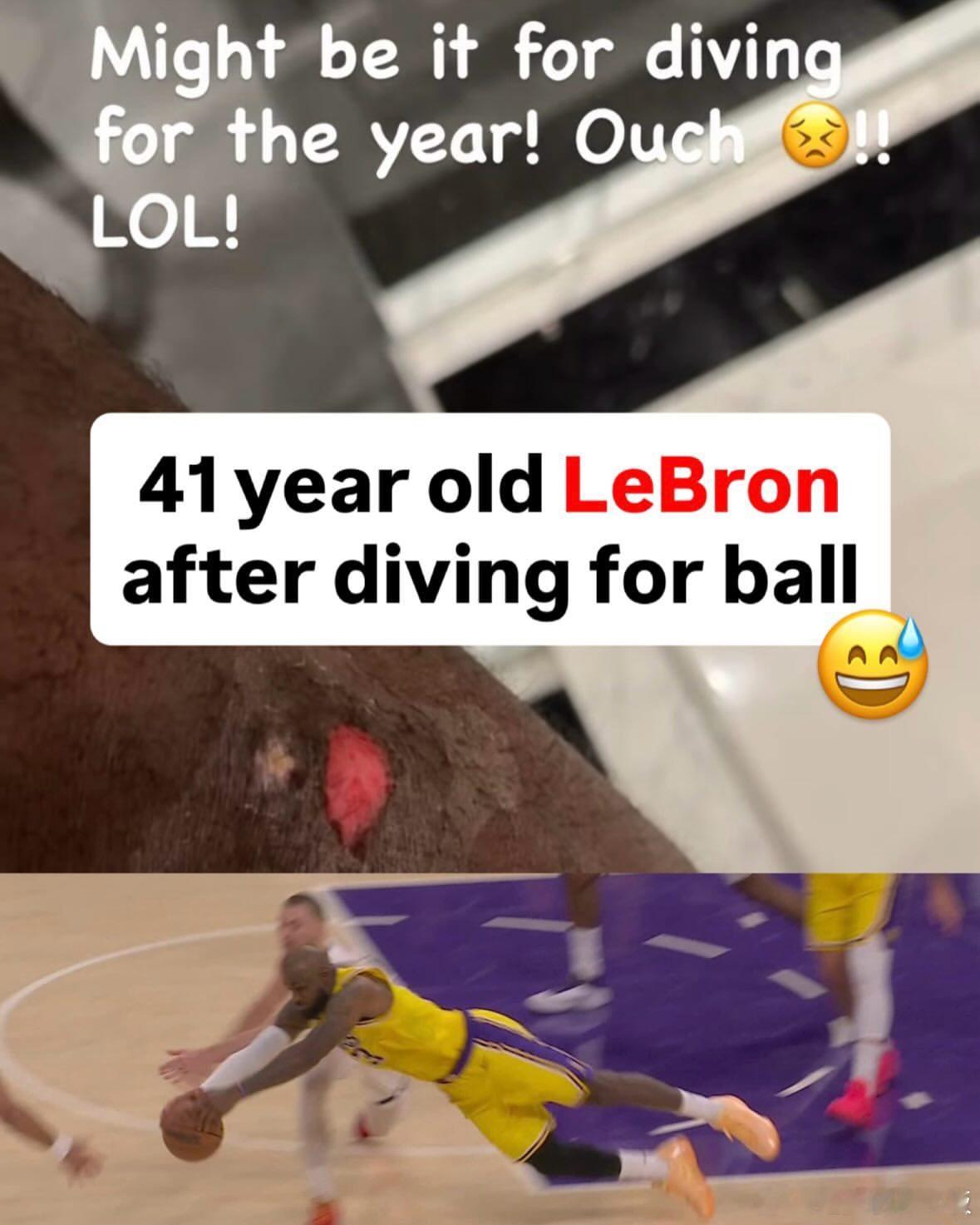 詹姆斯更新：鱼跃救球后留下的伤口“这球估计就是年度最佳扑球了！哎哟喂。😣哈哈！