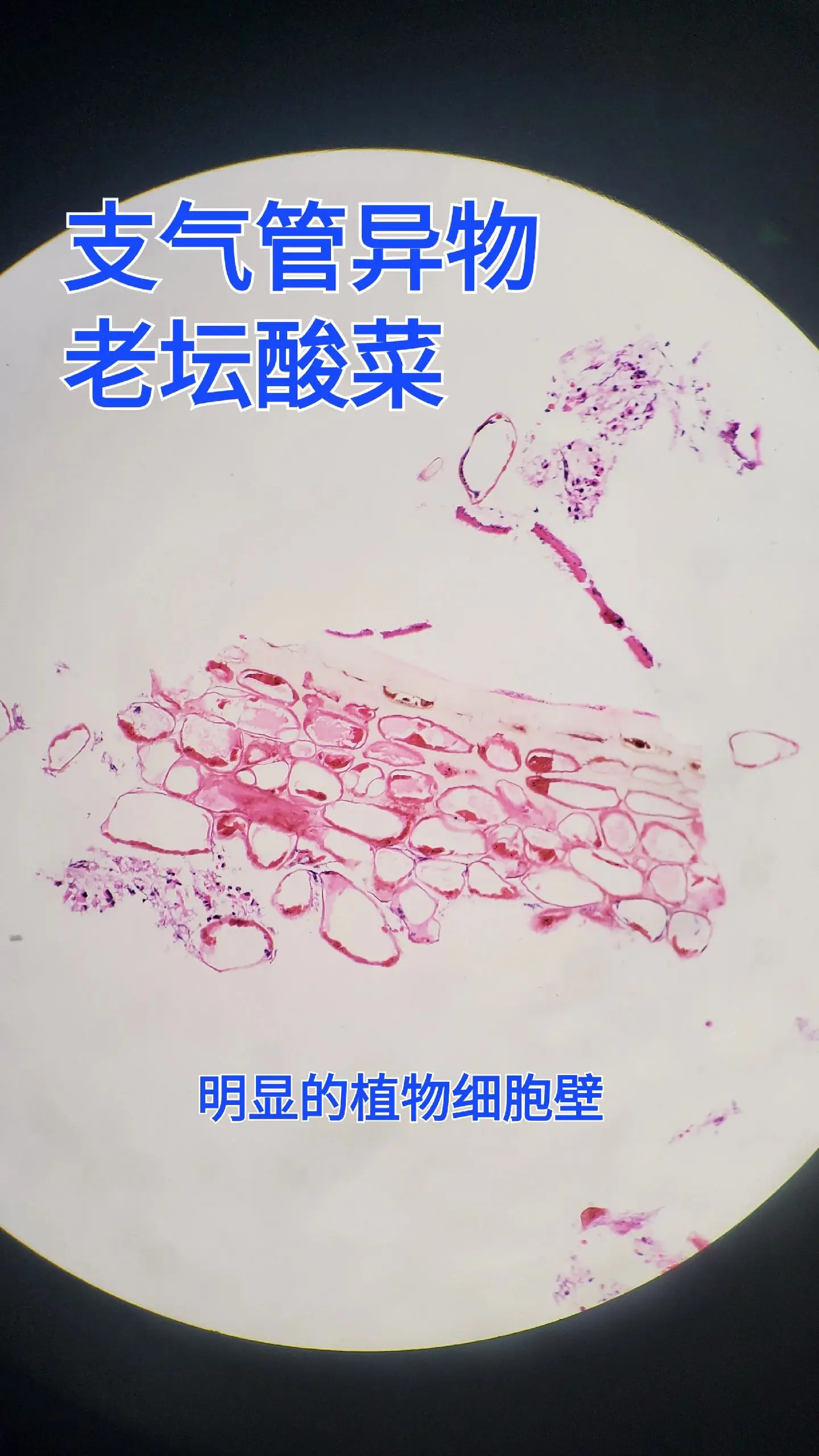 支气管异物