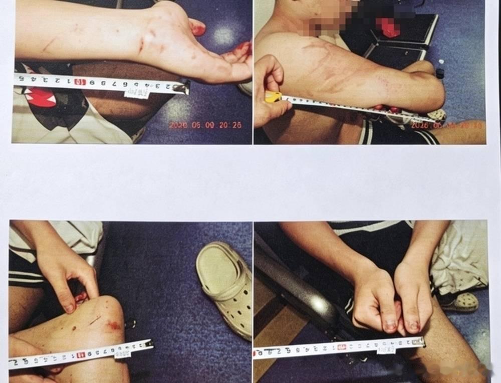 17岁男生家门口遭两次殴打案最新进展：伤情鉴定为轻伤二级，警方以涉嫌寻衅滋事罪进
