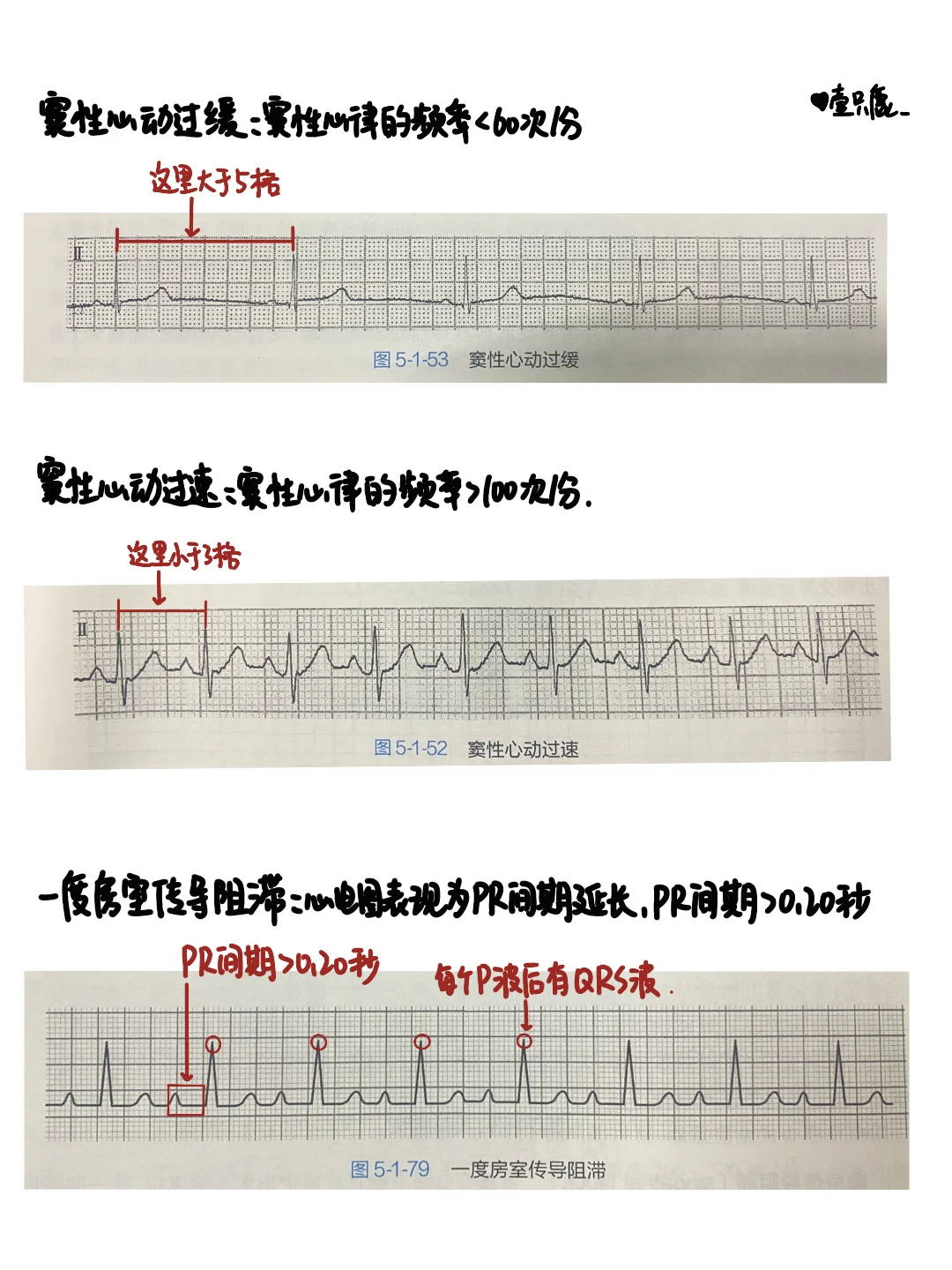 医学生笔记📒｜异常心电图解读👩‍⚕️
