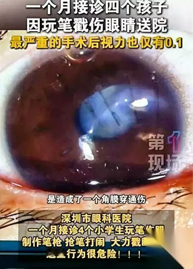 “笔”也能毁眼？

深圳4娃中招！

小强拿皮筋弹笔盖，一秒反弹，晶体炸裂，术后