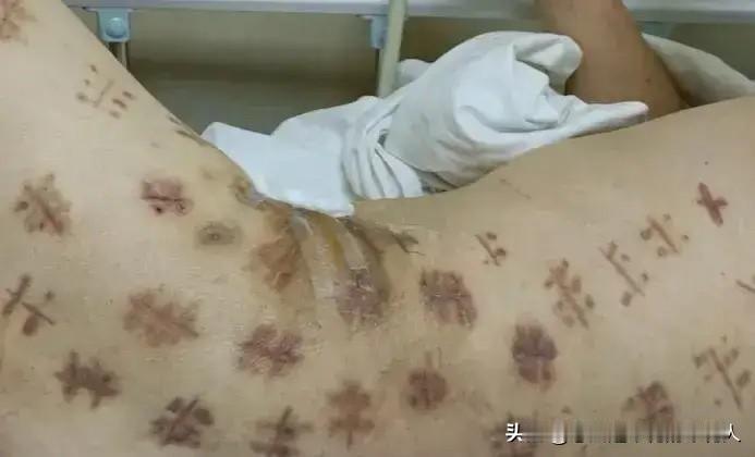 家人们，39岁的亿万富翁住进ICU，得的是肛周会阴坏死筋膜炎，这病真的凶险！他有