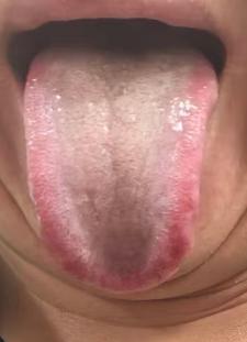 舌淡紫苔白润：脾肾亏虚命门火衰，宗筋不振如何论治







不少男性朋友遇到