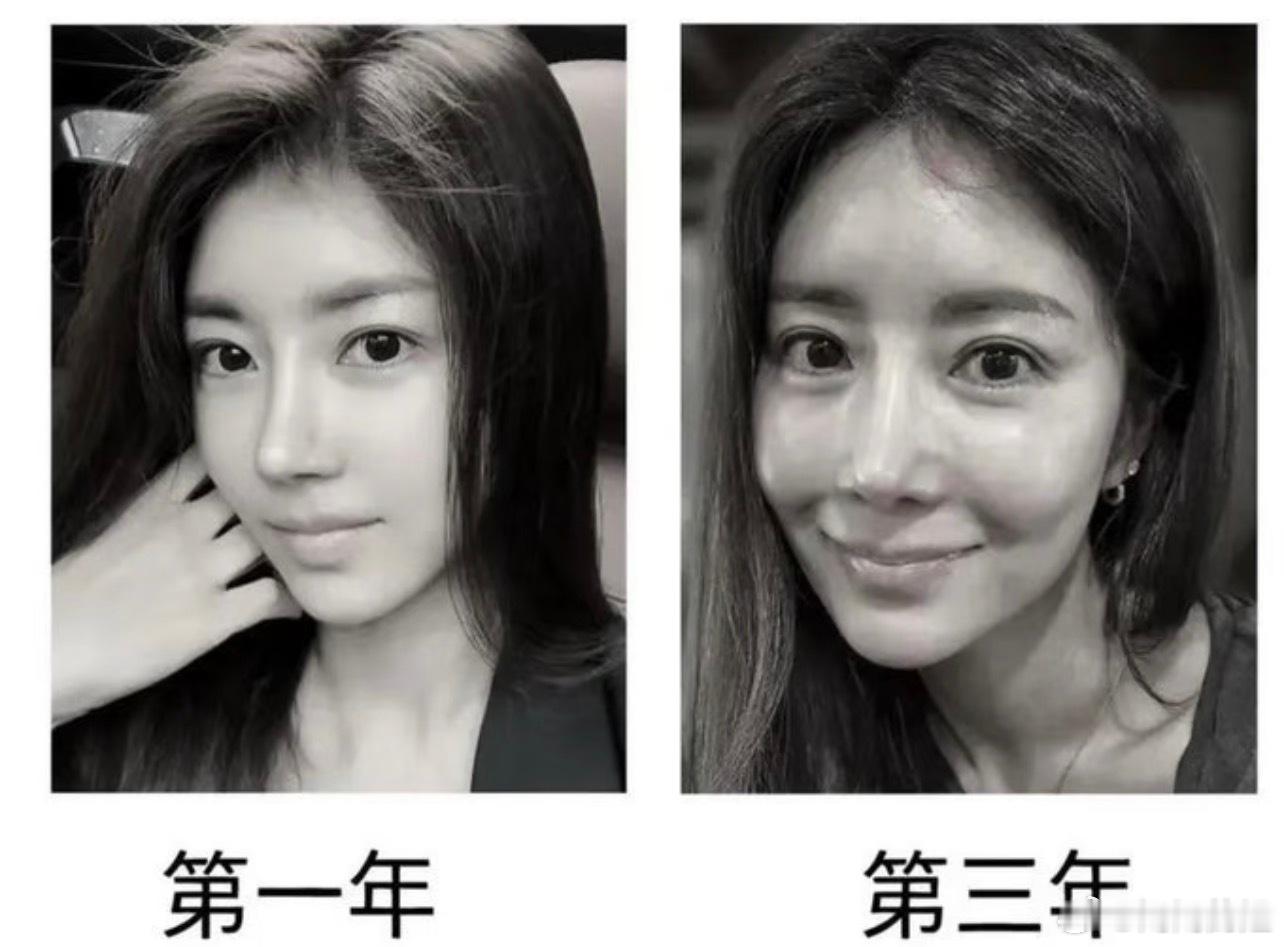 花三三又打了850支玻尿酸只贴过含玻尿酸的面膜护肤，直接注射实在不敢尝试玻尿酸后