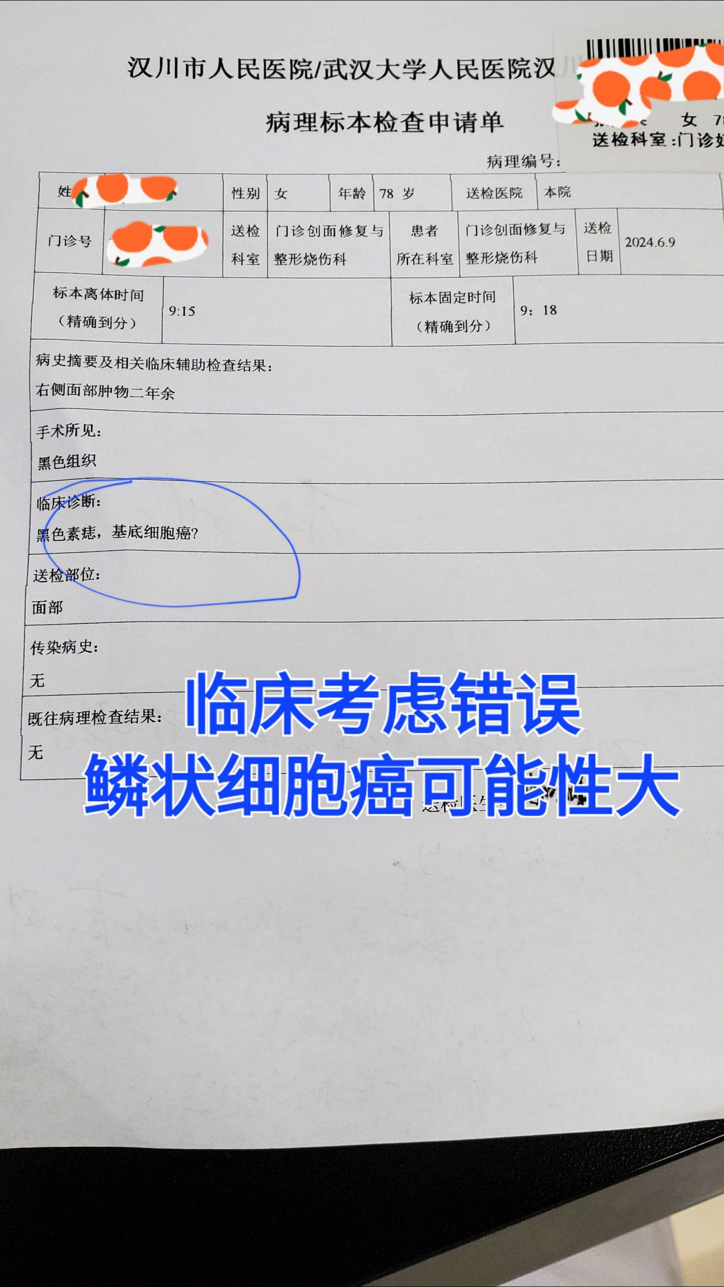 皮肤痣
鳞状细胞癌