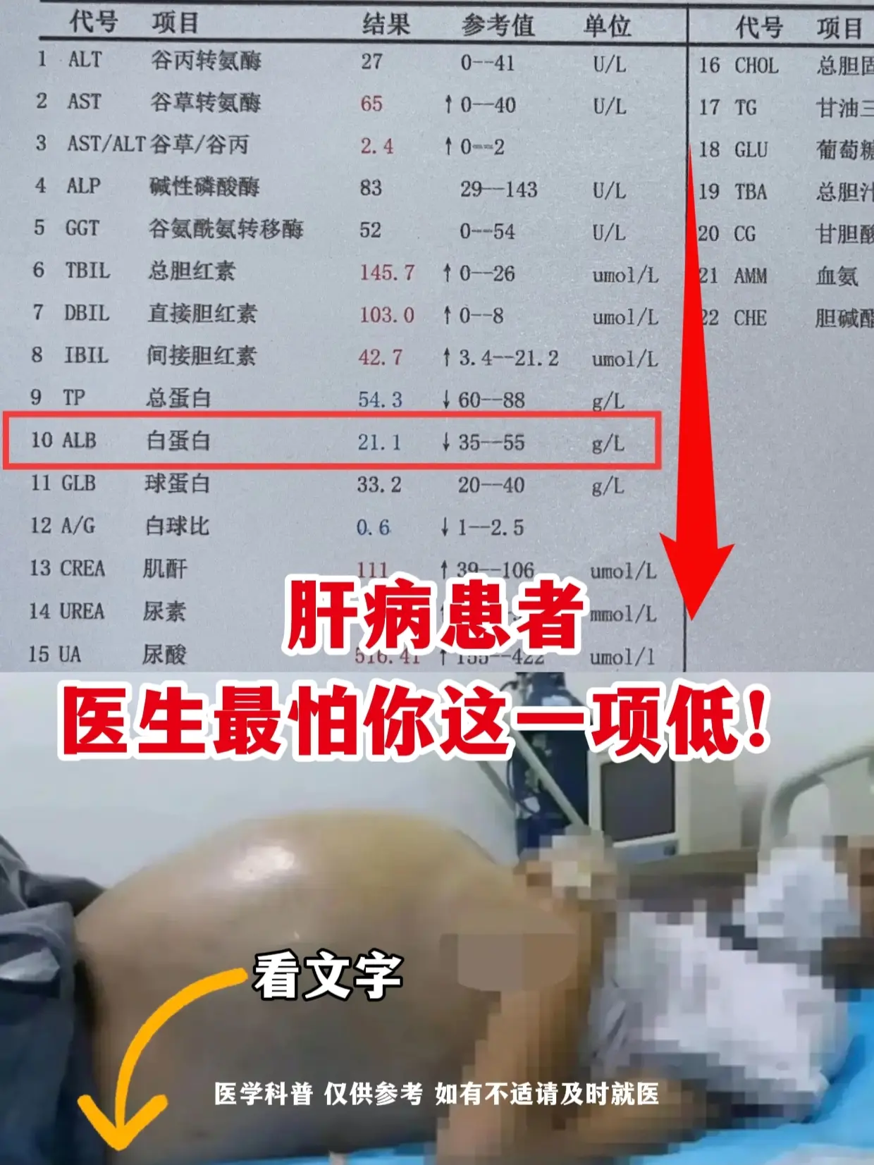 肝病患者，医生最怕你这一项低！。这位患者肝功能多项指标异常：总胆红素大...
