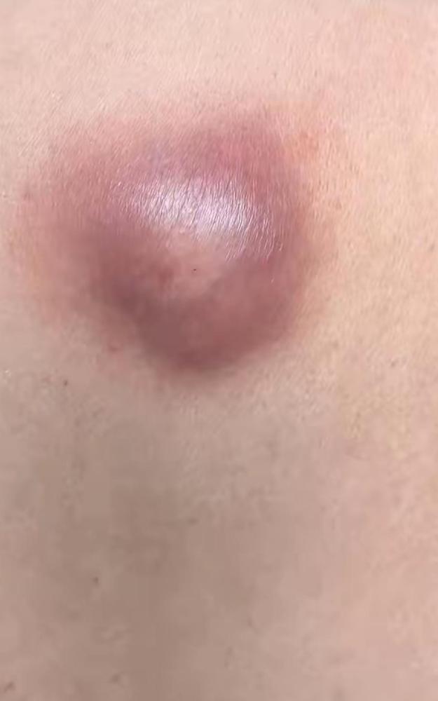 因为后背一个不痛不痒的疙瘩，一个同学生命永远定格在了58岁。

回头想李亮这件事