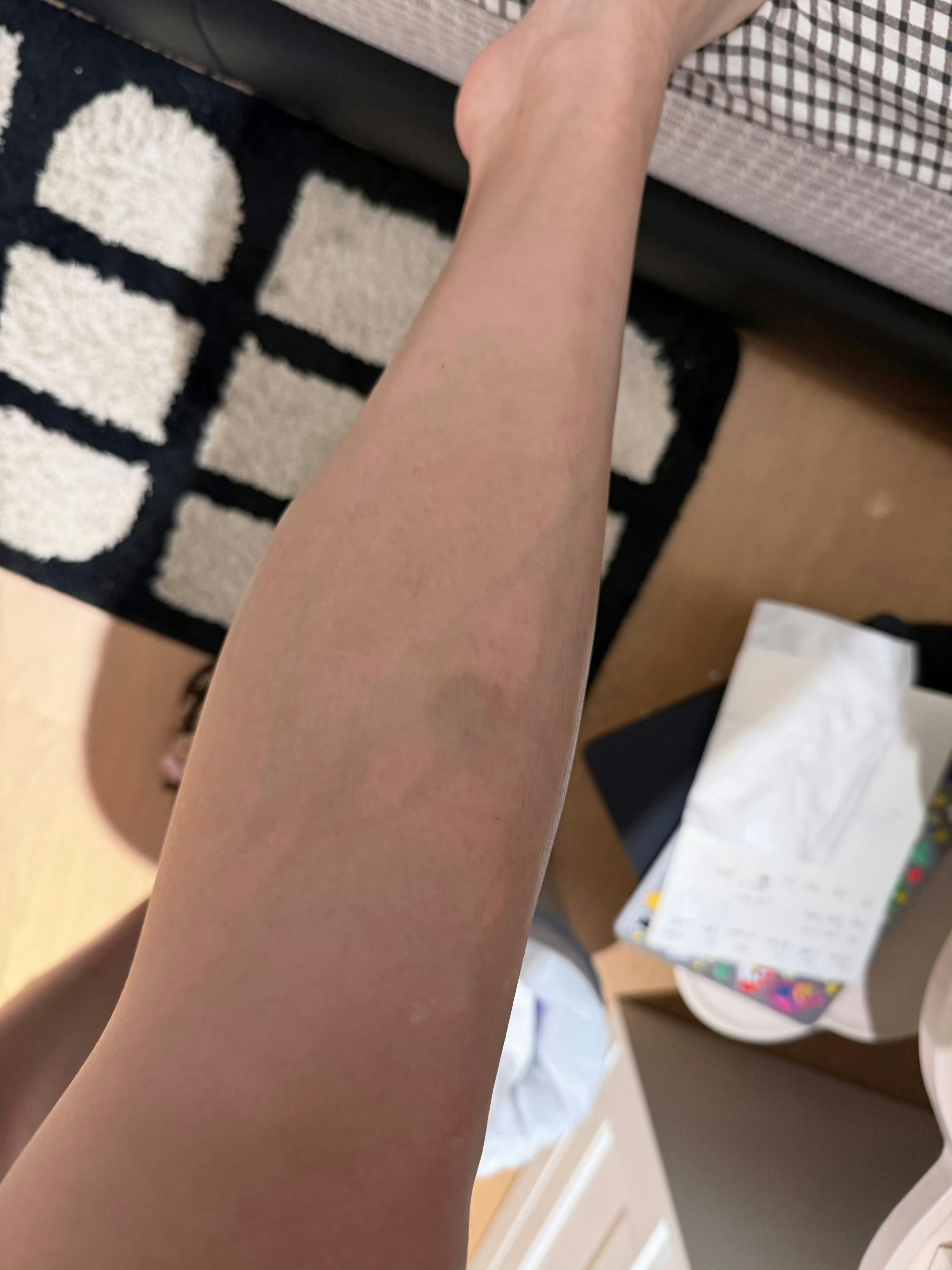 吴艳妮腿上好多淤青吴艳妮淤青腿 