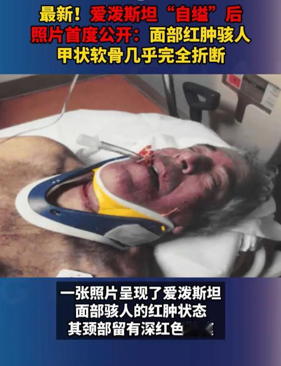 有没有学医的，自缢的话，会导致甲状软骨完全断裂吗（图四）？

仔细看，感觉力道非