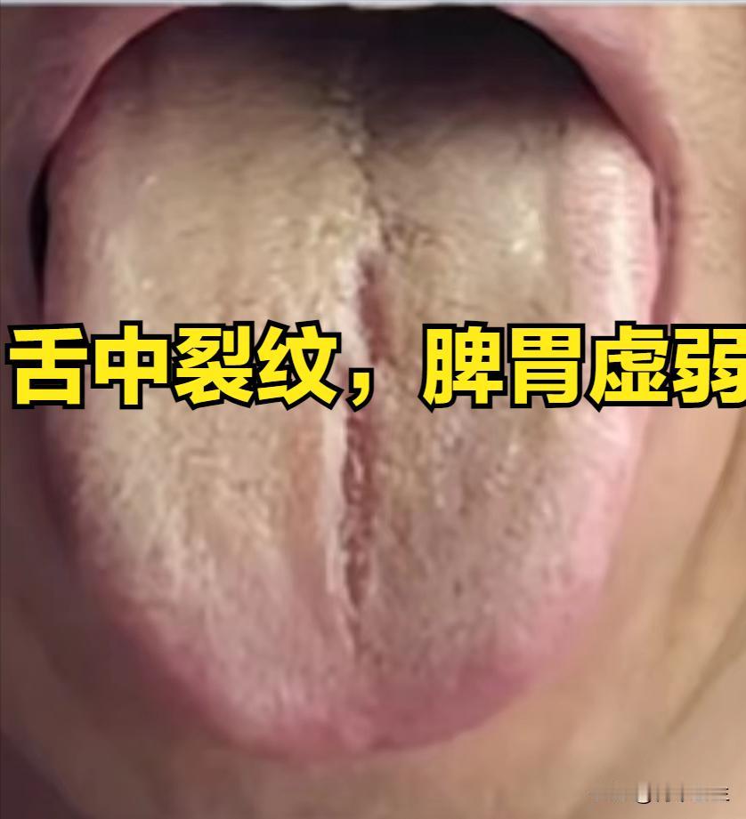 舌头有裂纹？这是身体在发求救信号，多是和这两个脏器有关系

1. 舌中有裂纹
脾