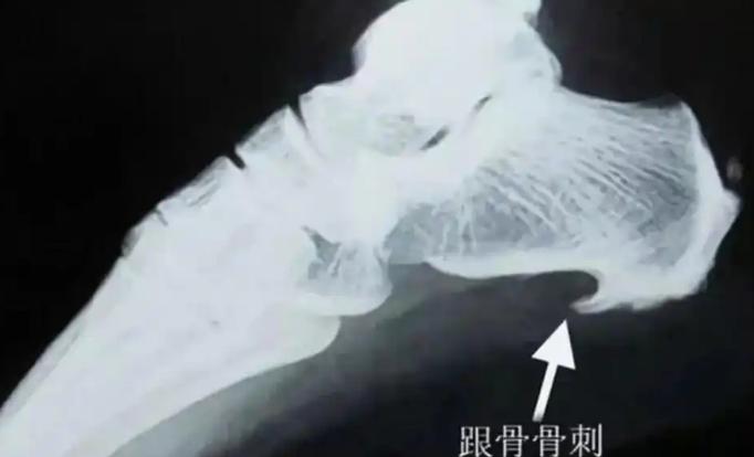 江苏一男子脚痛请病假，结果公司发现他请假当日的微信步数为16949步，门口监控显
