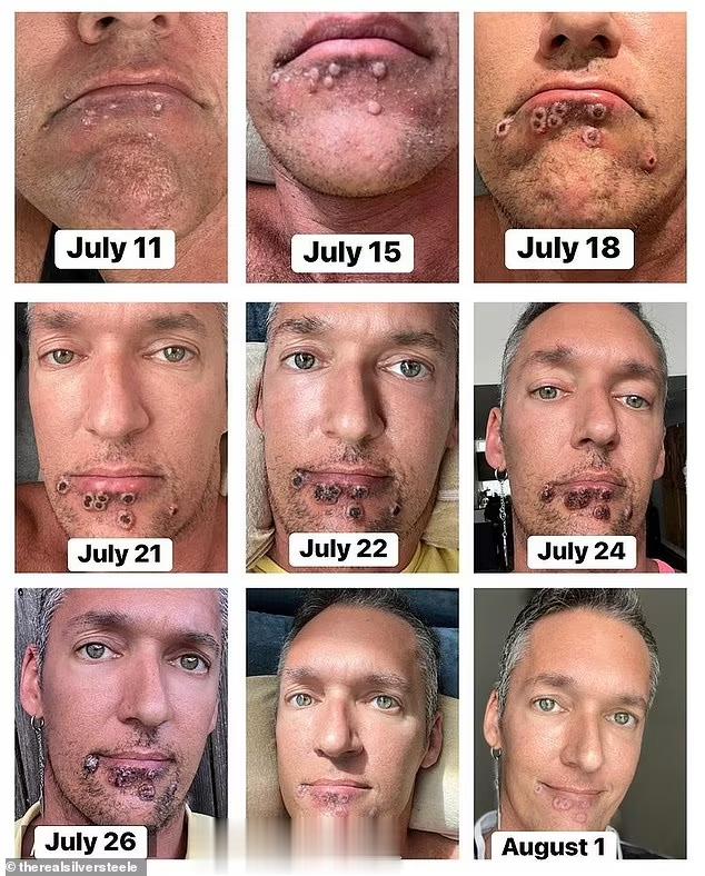 英国男子记录感染猴痘全过程：差点被毁容，每天如同酷刑…#陕西省发现一例猴痘病例#