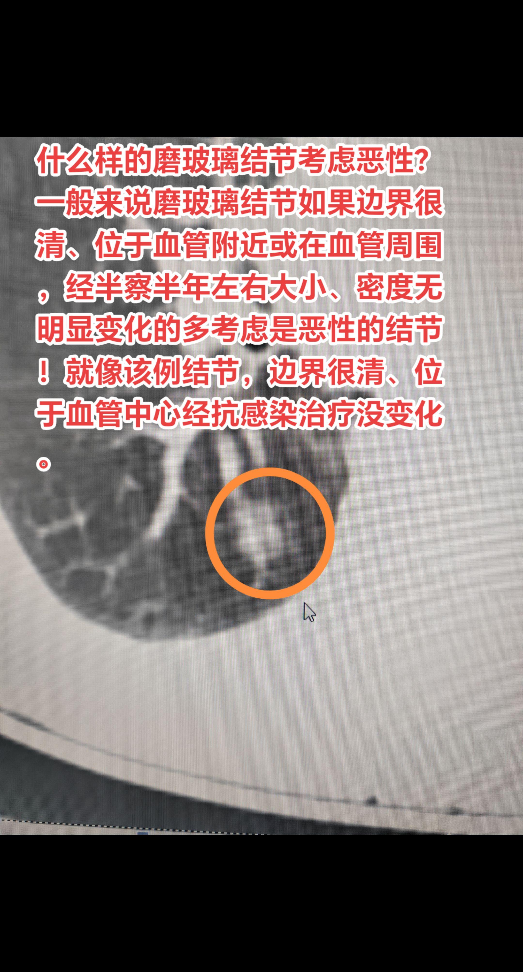 什么样的磨玻璃结节考虑恶性？一般来说磨玻璃结节如果边界很清、位于血管附...