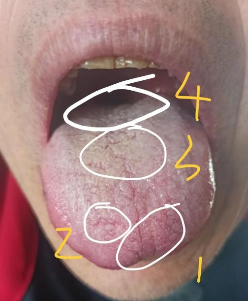 瞧这舌体胖大，舌质柔软，是不是感觉有点像“气不足，湿来凑”的感觉？没错，这就是气