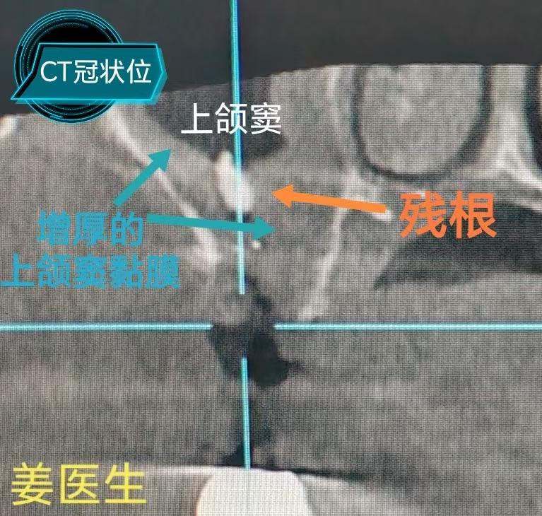 转诊病例。患者半月前拔牙“牙根进入上颌窦”，在同一医院做了两次手术仍未取出。通过上颌窦外侧壁开窗顺利取出！
当牙槽窝入路不能取出时，要改为上颌窦外侧壁入路，需要注意勿损伤上颌窦外侧壁血管，以免引起较大出血。