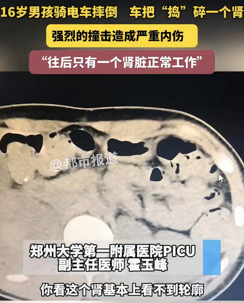 郑州16岁男孩骑车撞石头，肾直接碎了!医生：外表看着没事，里面全完了
晚上骑车太