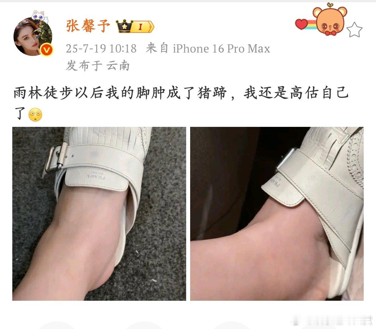 张馨予晒雨后徒步后的脚张馨予这次徒步后脚肿得像猪蹄，看来雨林的路确实不好走张馨予