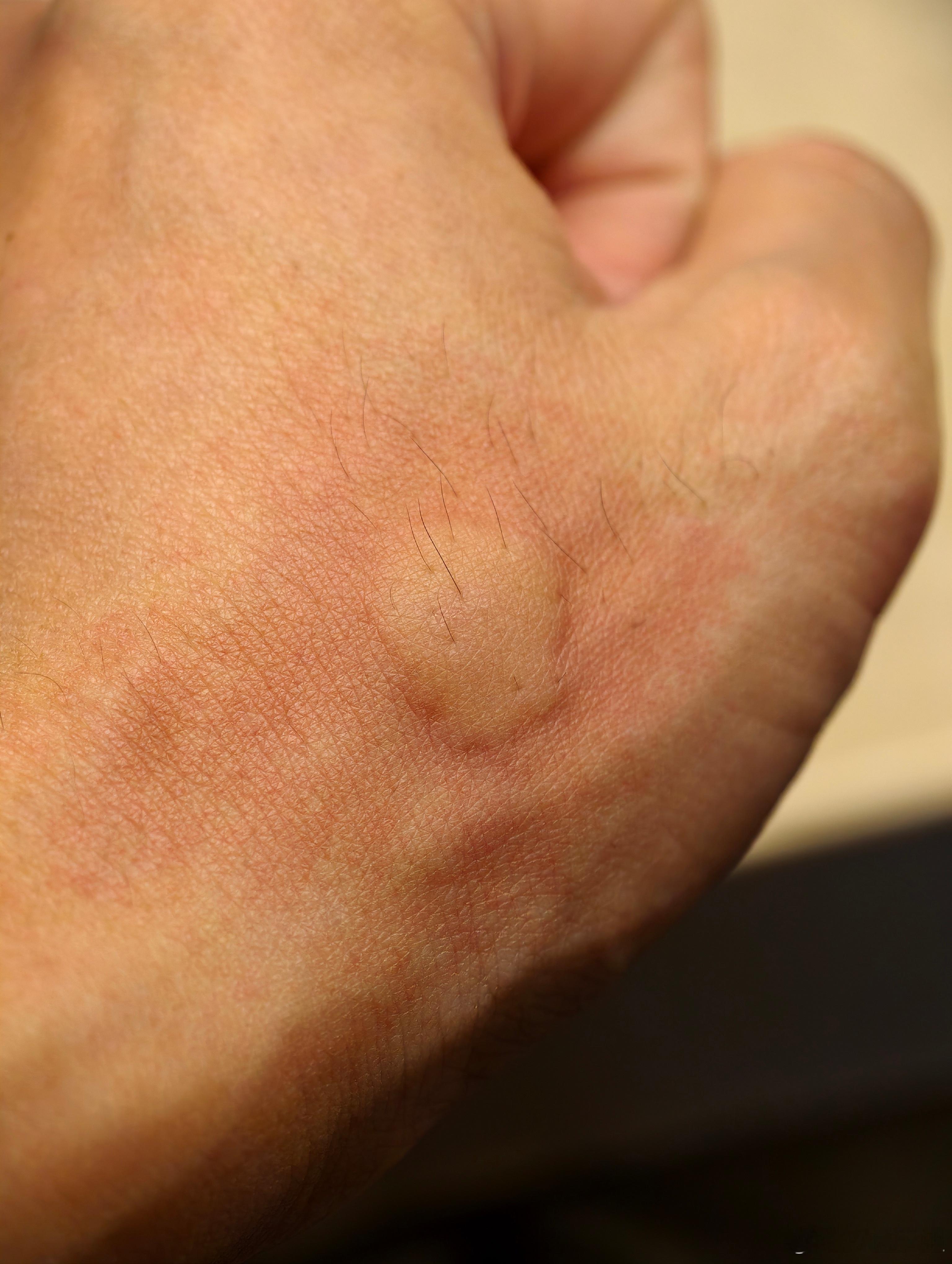 蚊子是饿疯了吗？一瞬间抽我这么多血？ ​​​