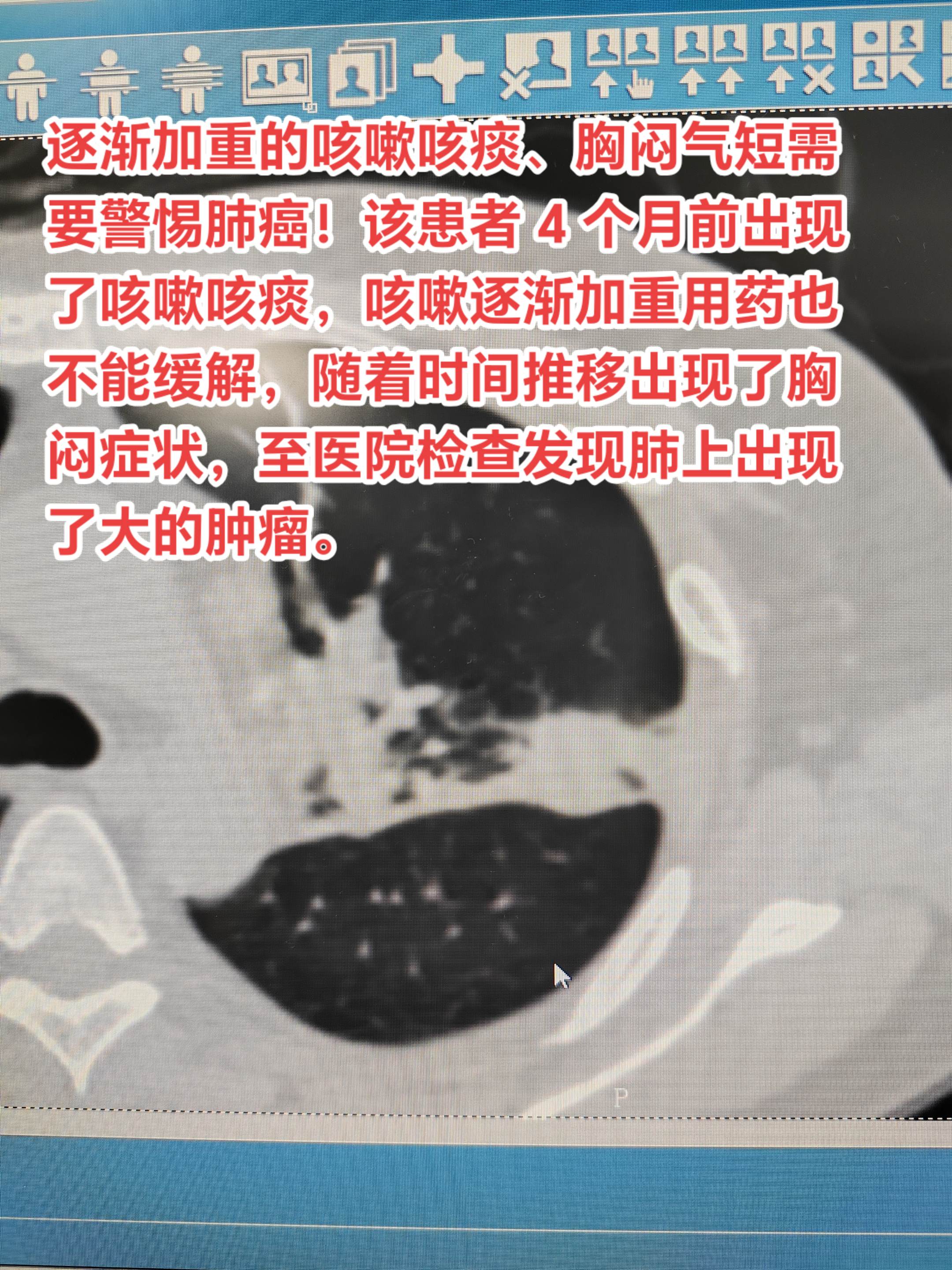 逐渐加重的咳嗽咳痰、胸闷气短需要警惕肺癌。该患者 4 个月前出现了咳嗽...