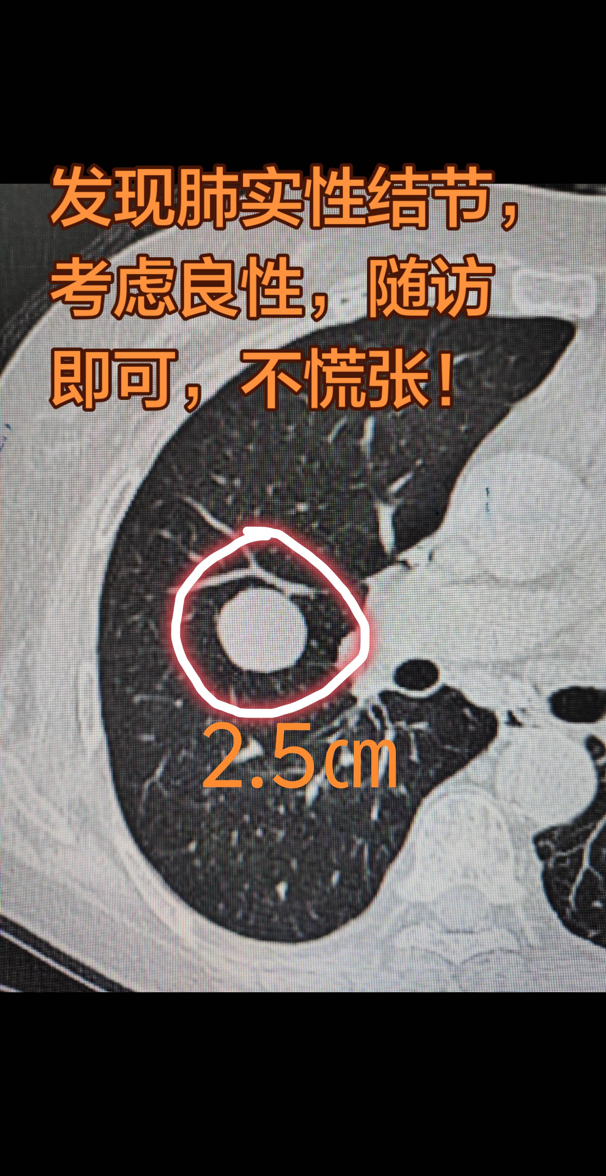 肺结节考虑良性的，长什么样。发现肺实性结节，考虑良性，随访即可，不慌张