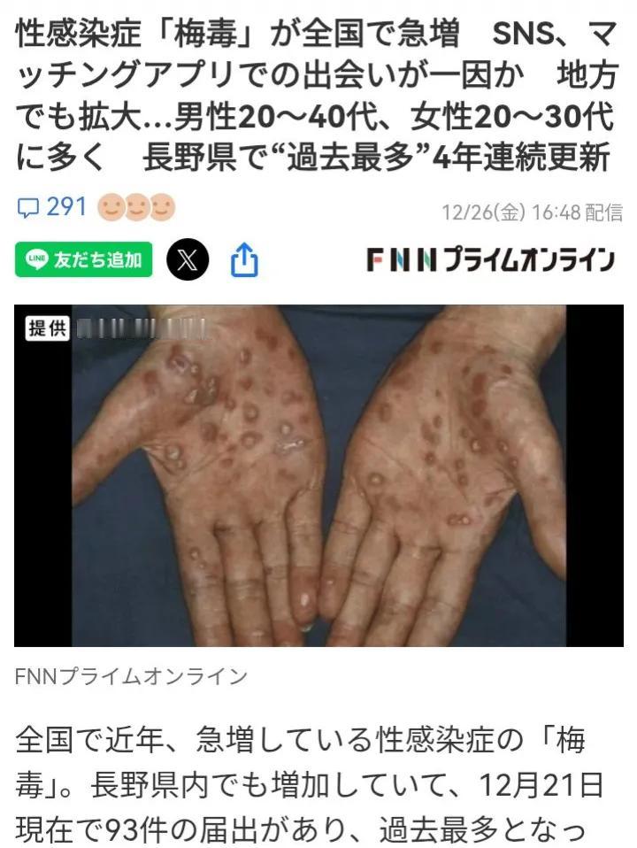 日本社会的梅毒已经泛滥成灾，人数爆发式增长。
据日媒FNN报道称，近年来，日本全