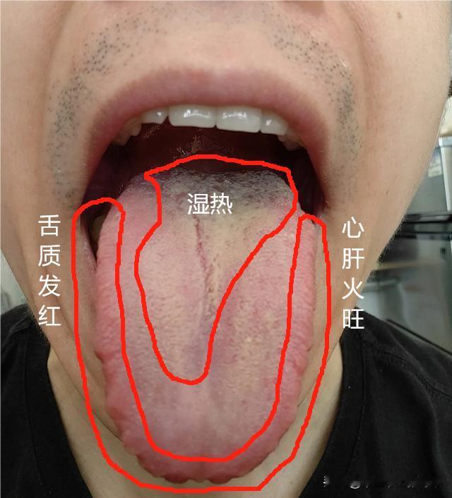 你这就差把你燃起来了，你看看你烧成啥了[发怒][发怒][发怒]
自己感觉是阴虚，