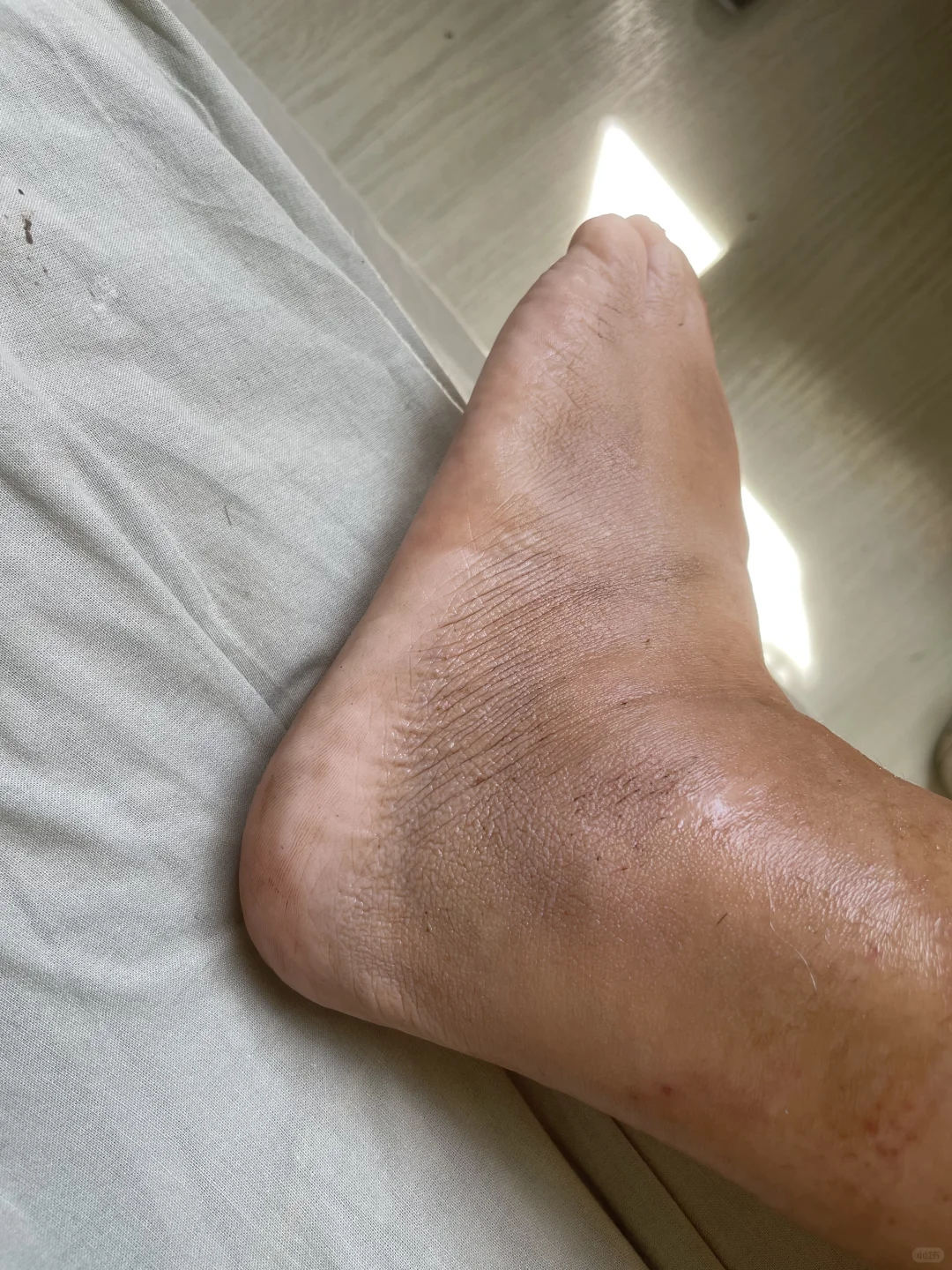 崴脚骨折一周，瘀血浮肿均消了