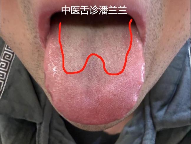 欲望特别强烈，身体早就挖空了！你吃再多的用六味地黄丸，根本没用的！
这位患者很有