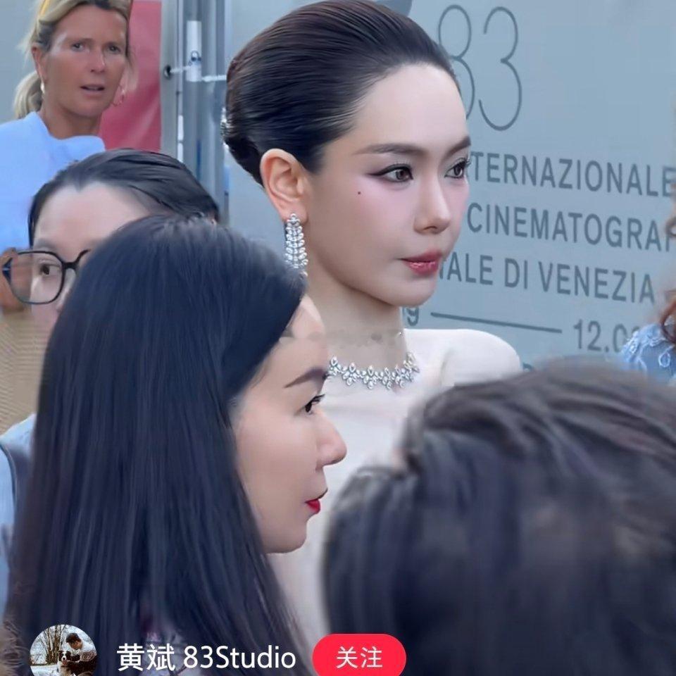 戚薇现在颜值回春，是打溶脂针打的吗❓其实我对于打溶脂针，让他脸变紧，是无语的因为