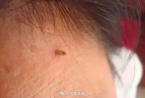 【#脖子上长出的小肉粒到底是啥#？该怎么治疗？】#女子让螳螂吃掉颈后肉瘊子# 生