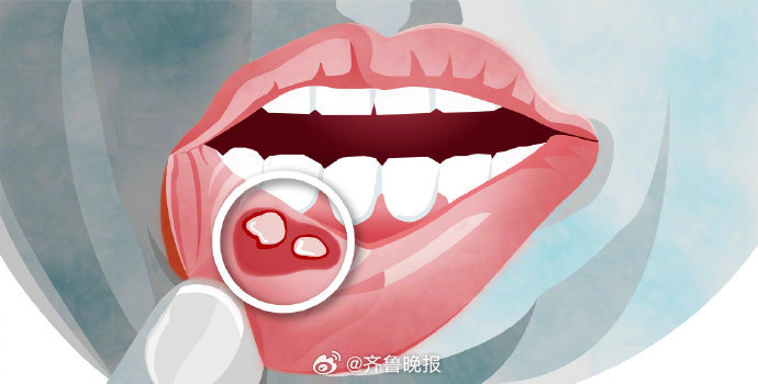#日常实用大全#【[话筒]注意！#口腔溃疡长期不愈小心癌症#】除子宫颈外，HPV