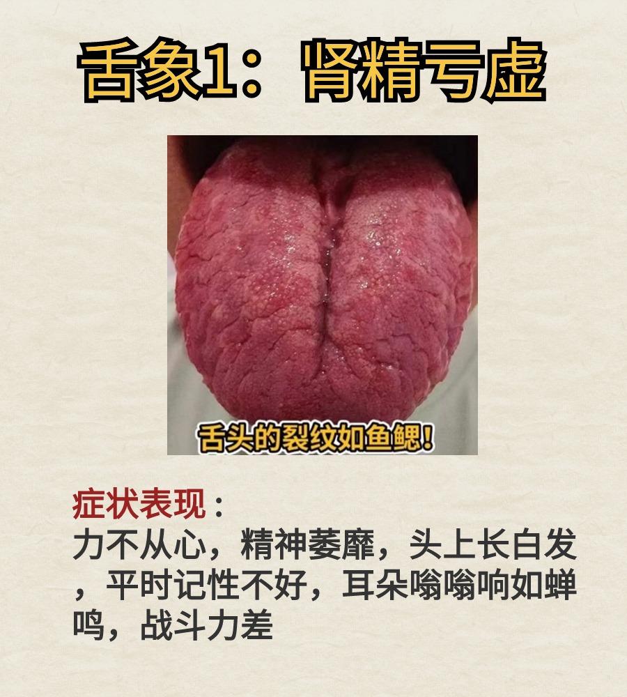 今日份舌象案例分析---肝郁化火，肾精亏虚