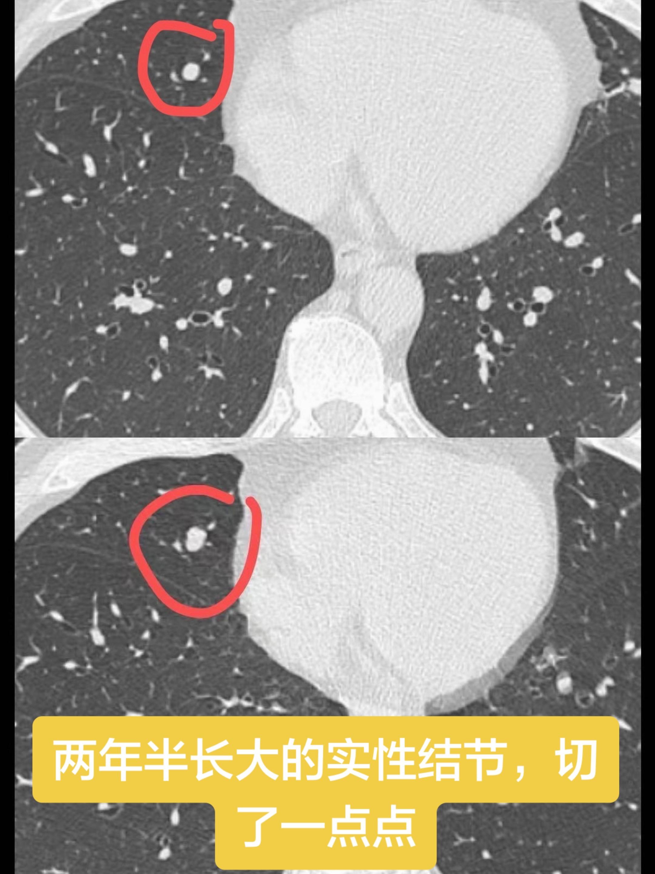 实性结节比较难判断，这个结节长大了，切了一点点，良性