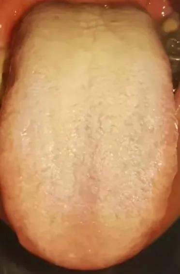 一种特殊的舌象，舌苔异常厚腻，显著痰湿症状，如果依赖六君子汤或二陈汤进行调治，往
