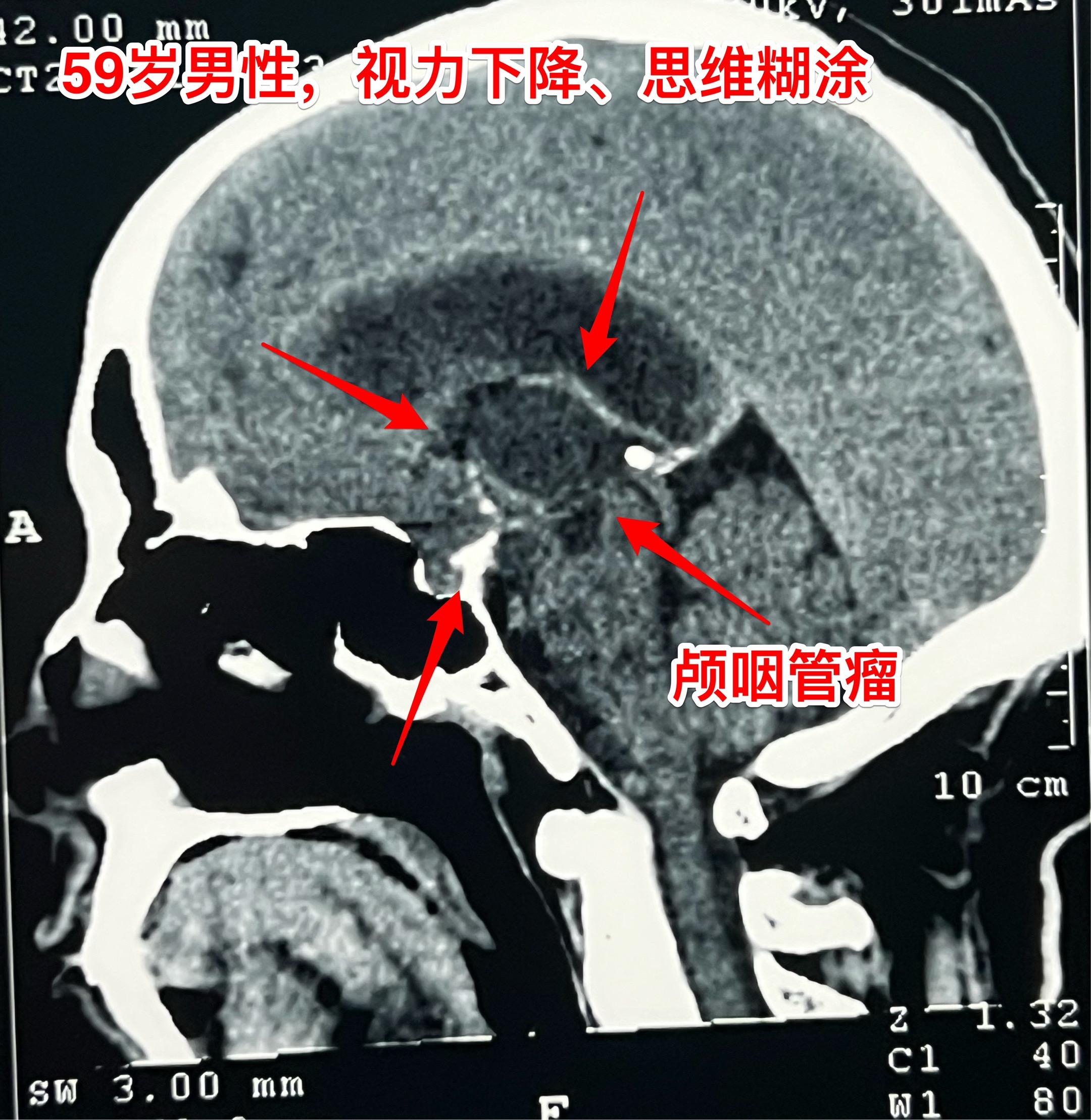 周日加班完成两台颅咽管瘤手术（第167）2025年10月26日（周日）...