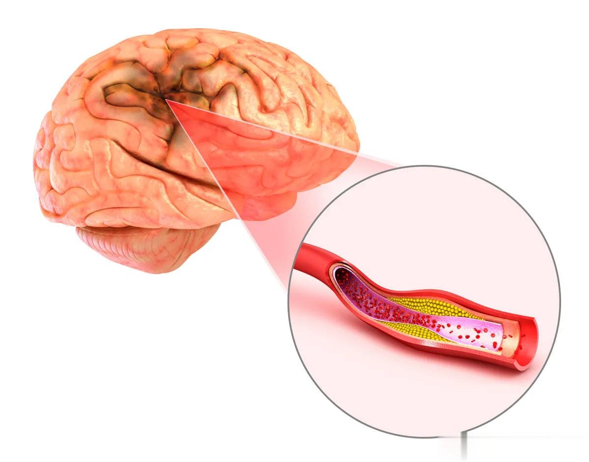 脑梗病人不愿吃阿司匹林和他汀，吃三七粉行不行？答案是：不行！三七是我国中医药中的