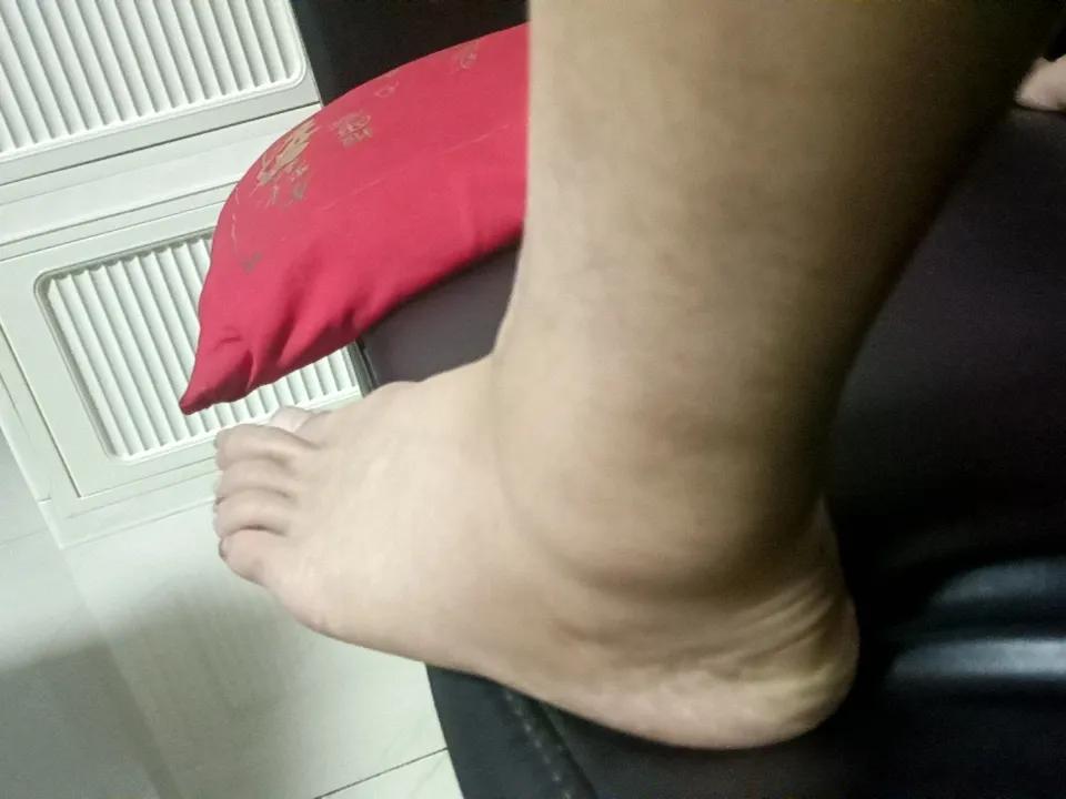 今天运气不好，中午在昊天山水坐电梯，感觉左脚一阵疼痛，赶紧把裤子撸起来一看，居然