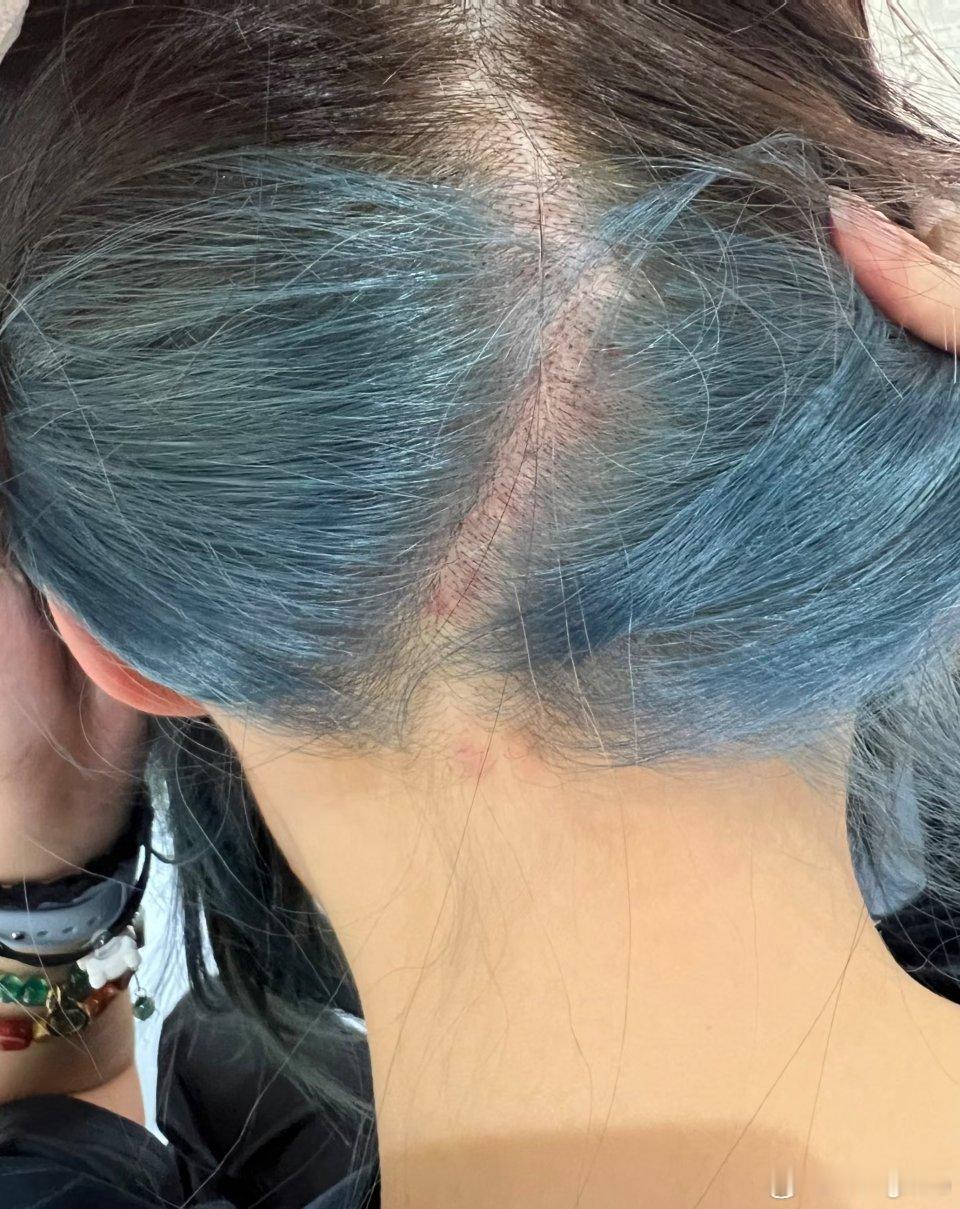 女子染发头皮溃烂过年只能光头之前看到的我都不敢染发了 